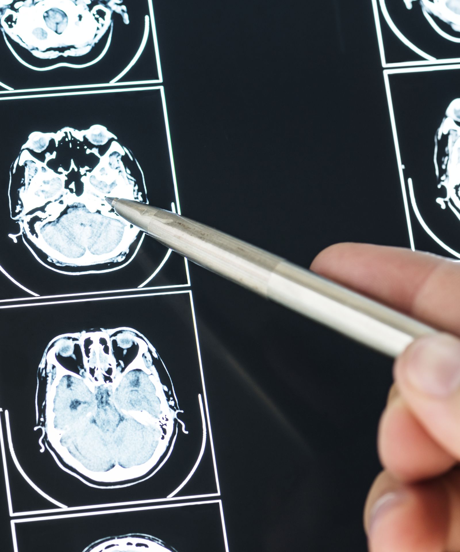 Monitoraggio dell’Evoluzione di Patologie Neurologiche